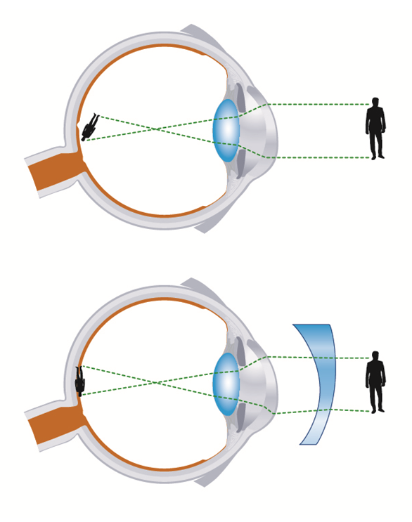 屈折異常(近視・遠視・乱視)の矯正法・治療法｜丸亀市のひらの眼科