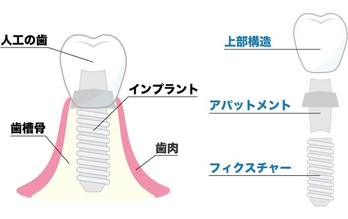 インプラントの噛み合わせはなぜ重要？天然歯との違いと咬合調整が必要