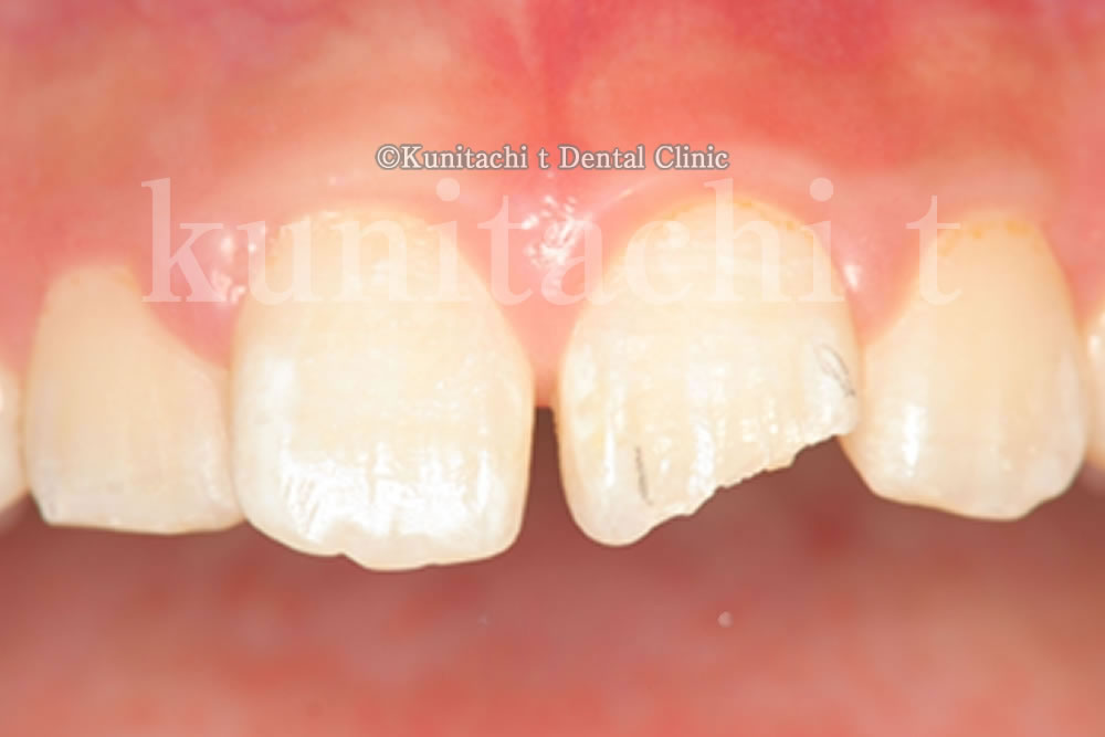 審美歯科 | 国立t歯科