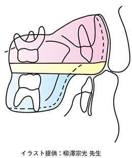 ムーシールド〔反対咬合用〕S・M《在庫限り》 | 株式会社 JM Ortho