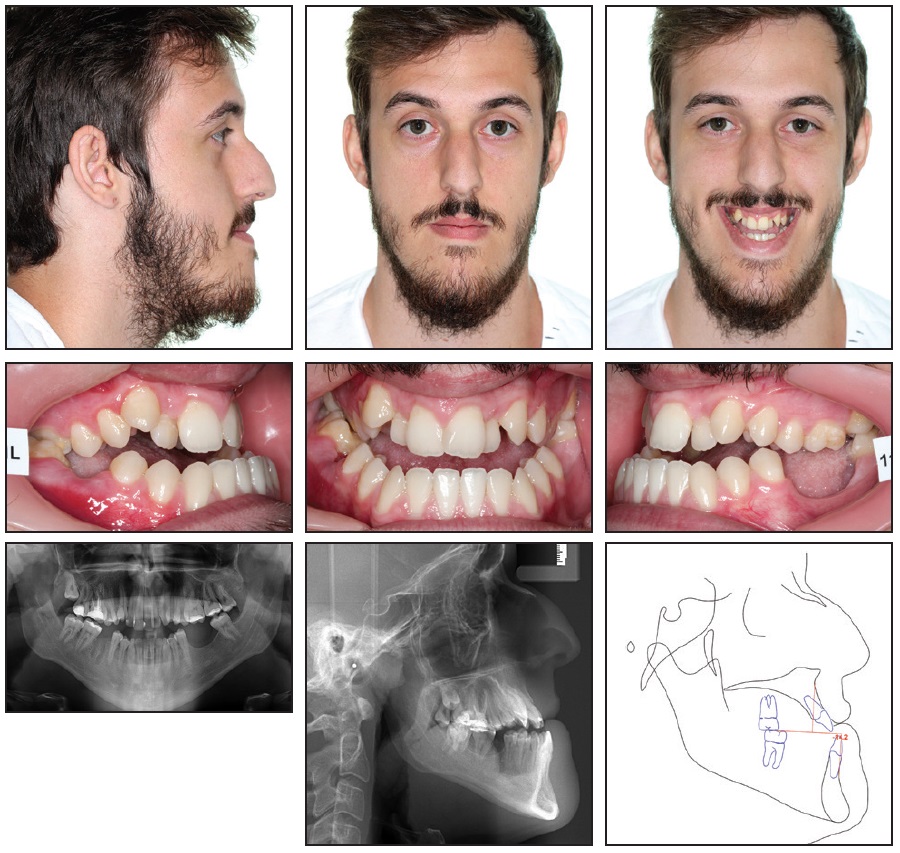 Carriere Nonsurgical Class III Open Bite Correction from JCO