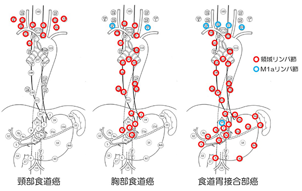 食道がん｜がんに関する情報｜がん研有明病院