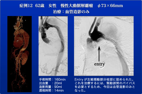 第5回 Japan Endovascular Symposium｜症例経過報告