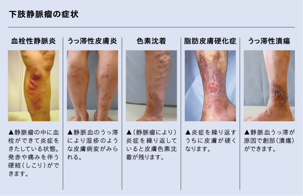 血管内治療特集 | 医療法人社団 慈恵会 新須磨病院 兵庫（須磨/神戸）