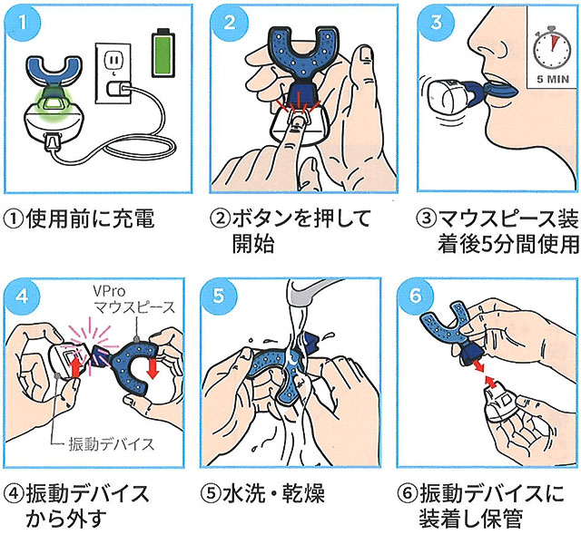 シュアスマイルVPro（振動型アライナー補助装置）｜大阪矯正歯科グループ