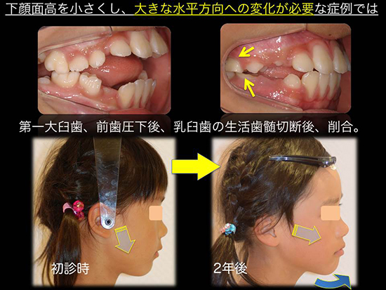 なんでもTopics｜矯正歯科の診断・治療法｜日本フェイシャルオーソトロ