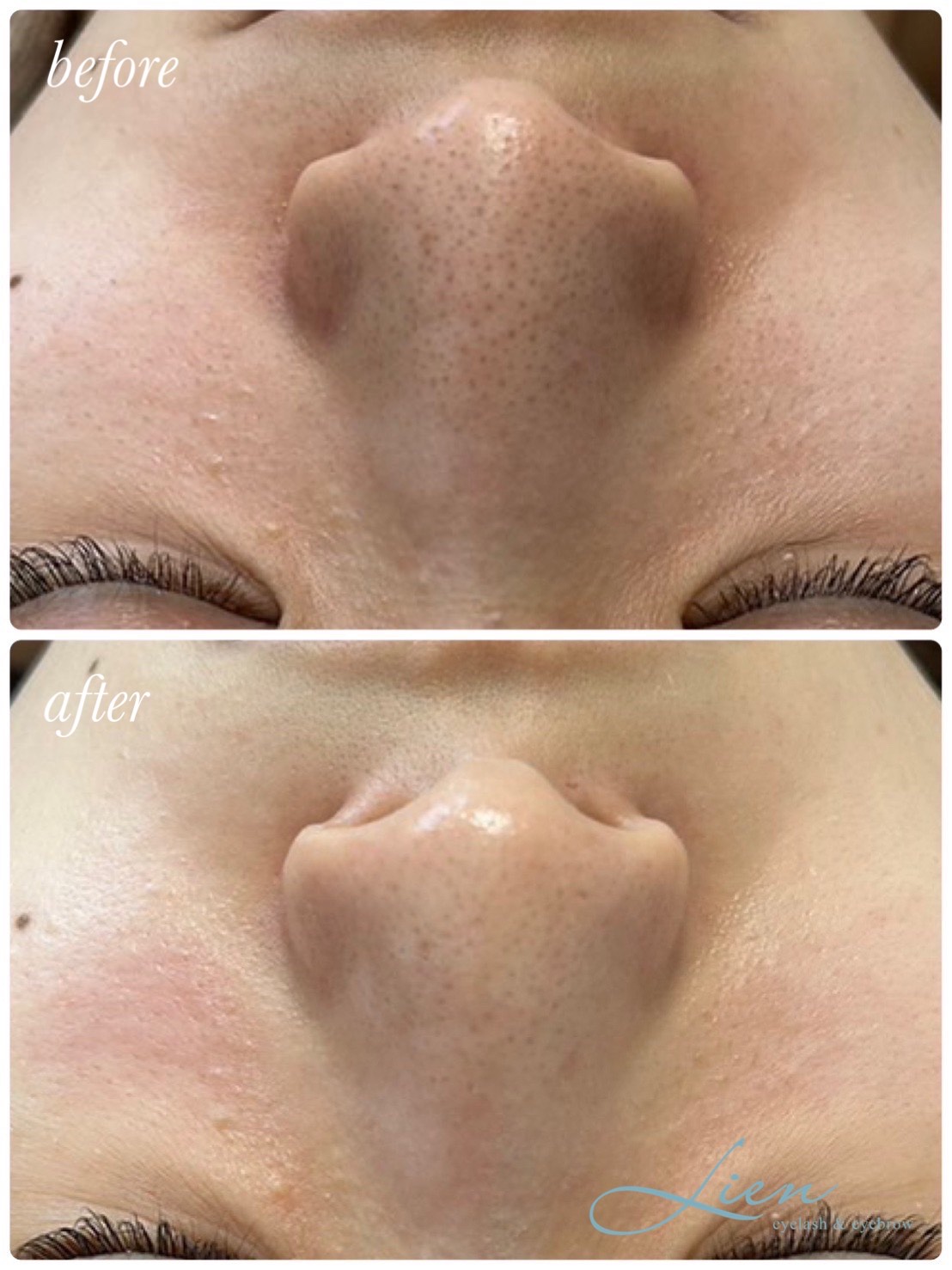 ハイドラフェイシャル・毛穴洗浄について - Lien【リアン】