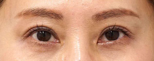 眼瞼下垂手術 | もとび美容外科クリニック