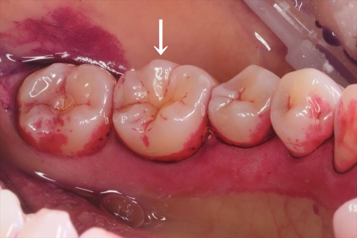 ヒビの入っていた左下第一大臼歯をセラミック修復しました。2025.04.11