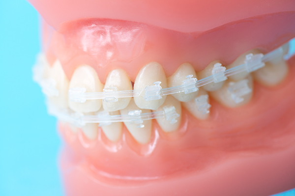 矯正歯科｜予防重視の宇都宮市の歯医者｜みき・さくら歯科