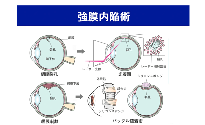 網膜剥離 | 診療内容 | 南眼科
