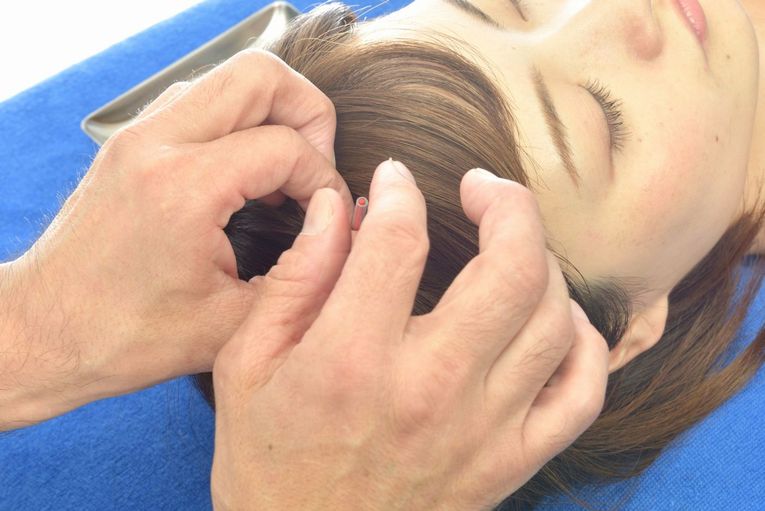 YNSA®（山元式新頭鍼療法：Yamamoto New Scalp Acupuncture）| 目黒区