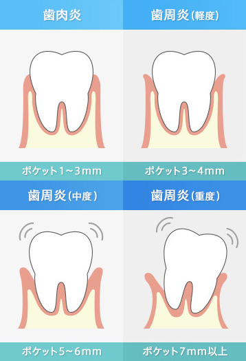 歯周病 | 錦糸町で40年続く歯医者さん 中沢歯科医院