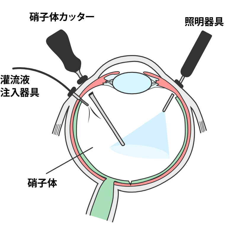 網膜硝子体手術について｜西台眼科クリニック