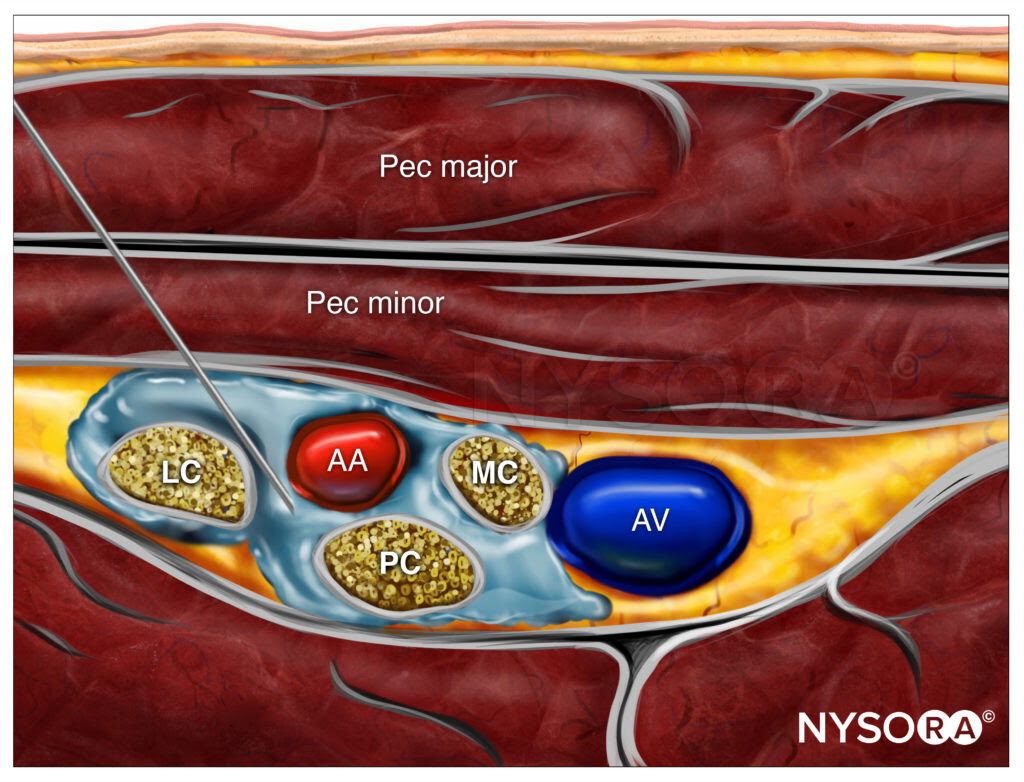 From the desk of Dr. Hadzic: The Case for Nerve Stimulators - NYSORA