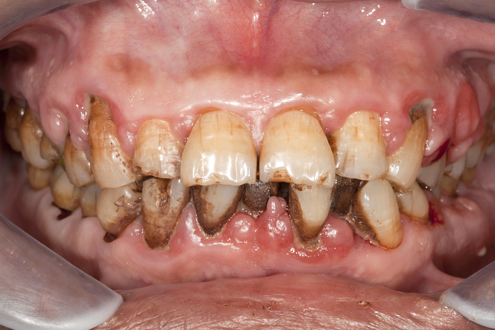 名古屋・小牧・岐阜で「ボロボロの歯の総合治療」｜医療法人スマイル