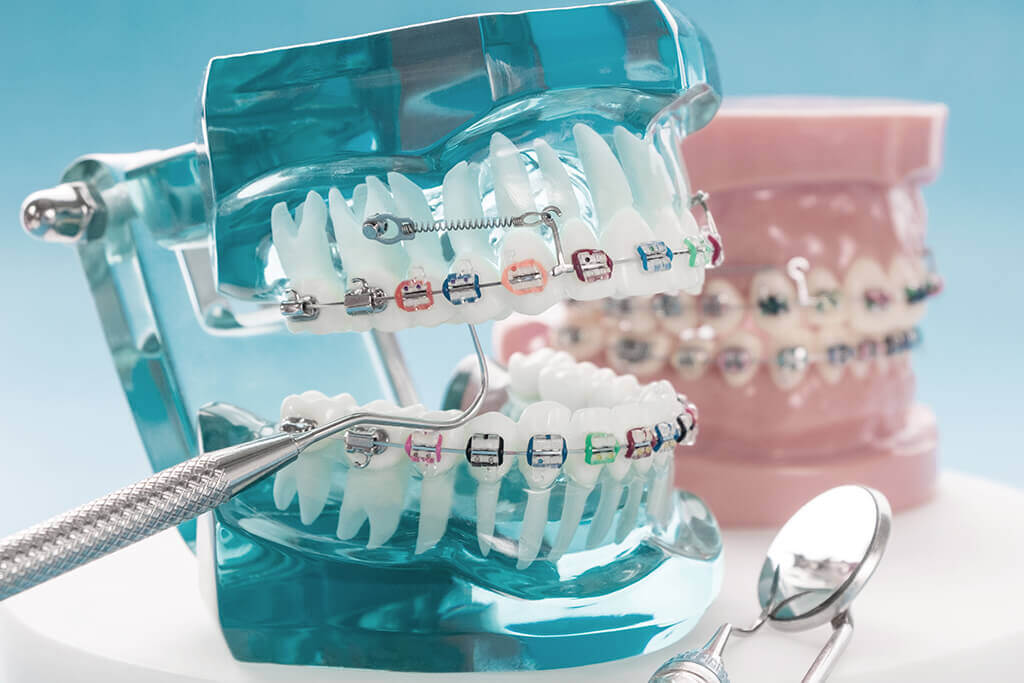 矯正治療 | 裾野市の歯科・歯医者｜しぶやデンタルクリニック