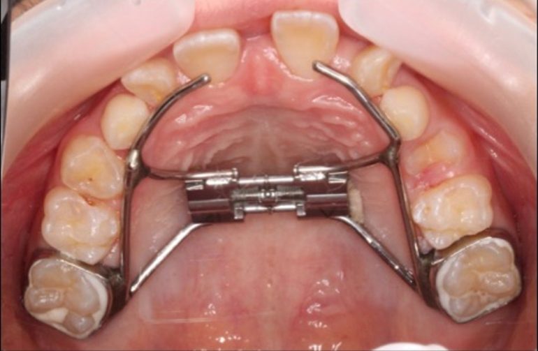 天王寺区で小児矯正は玉造駅すぐのしょうはら歯科へ