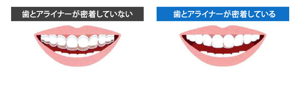 マウスピース型矯正装置治療の加速装置について | 巣鴨の歯医者