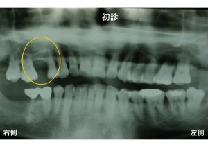 上顎洞底挙上術（サイナスリフト法） | インプラントや歯周病治療は