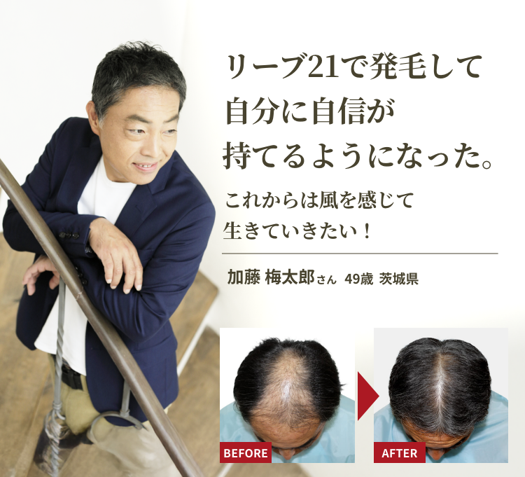 オウサムクラスEX|選ばれたあなたのためのプレミアムな発毛体験-