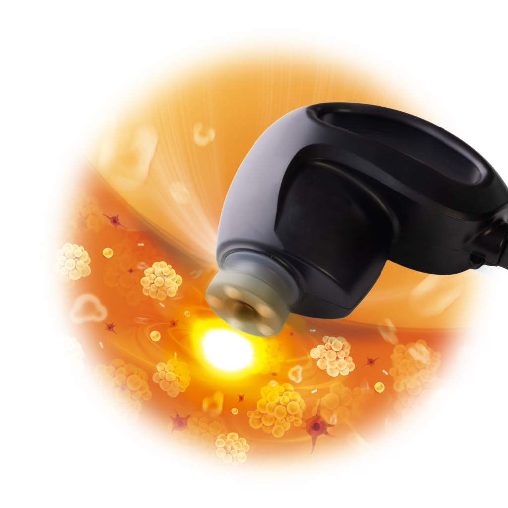 サーモシェイプOpus