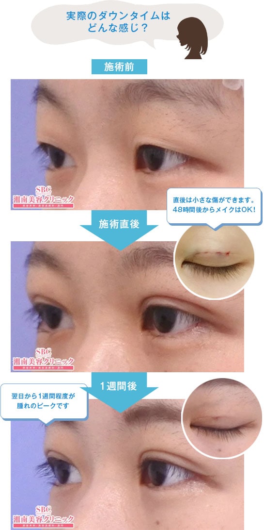 Teen二重®｜二重・目元整形なら湘南美容クリニック【公式】