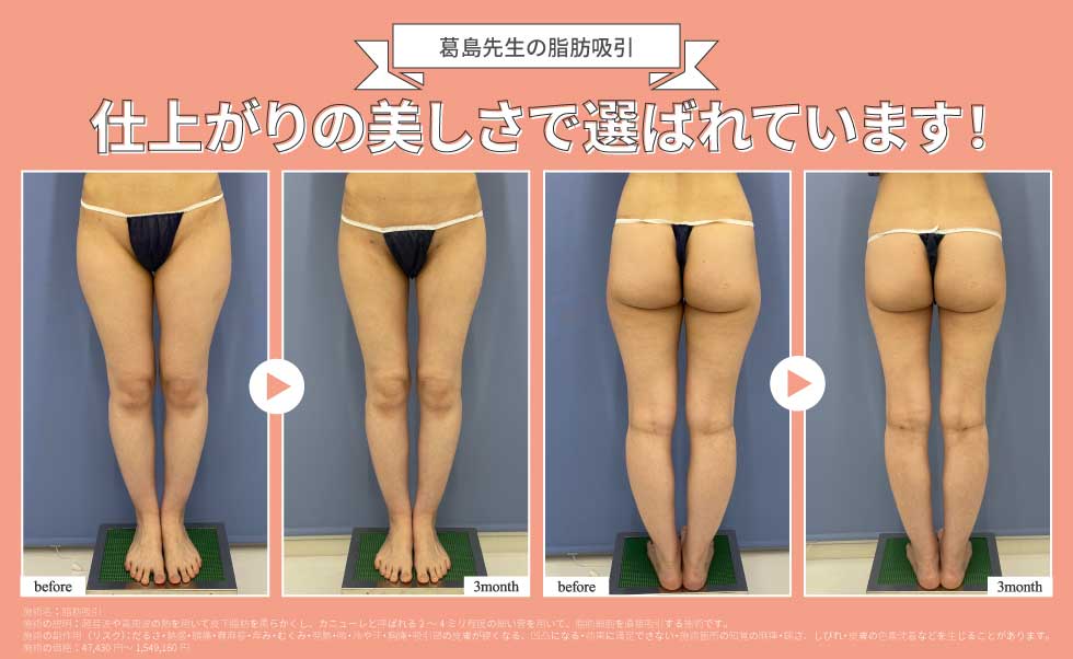 脚の脂肪吸引なら脂肪吸引の名医・くずしま先生にお任せください