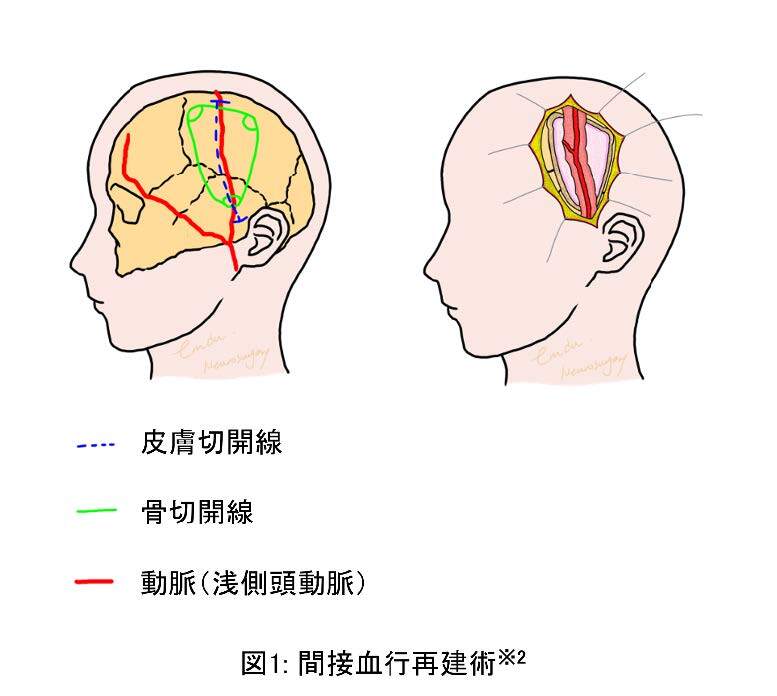 小児もやもや病における間接血行再建術後の脳室吻合チャネル退縮