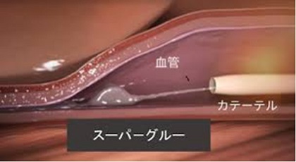 低侵襲心臓手術｜社会医療法人禎心会 札幌禎心会病院