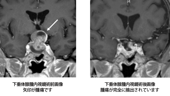 21．神経内視鏡手術、低侵襲手術についてあれこれ │ チーム脳外