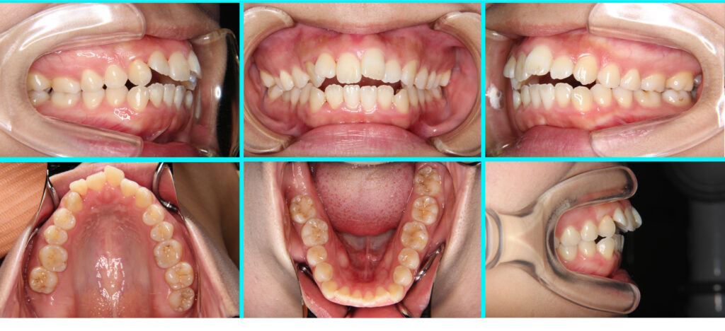 41] リンガルブラケット矯正法｜たまむら矯正歯科｜尼崎・伊丹の矯正