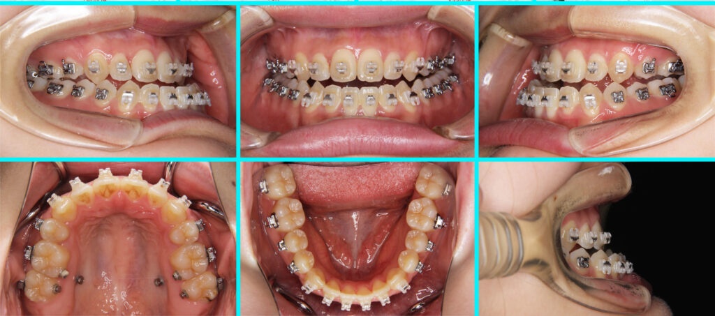 31] 反対咬合・外科矯正｜たまむら矯正歯科｜尼崎・伊丹の矯正歯科