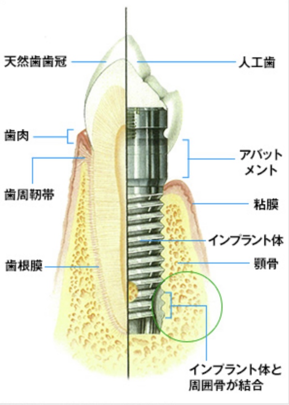 インプラント治療 : タニダ歯科医院｜西宮・宝塚・三田の歯医者