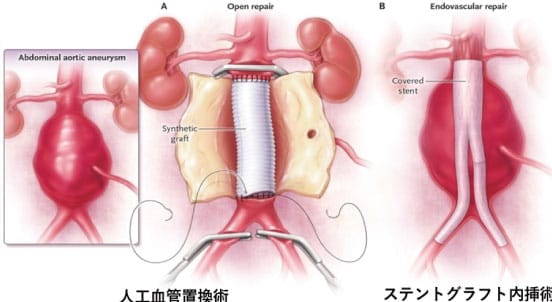 腹部大動脈瘤に対する人工血管置換術、ステントグラフト内挿術｜社会