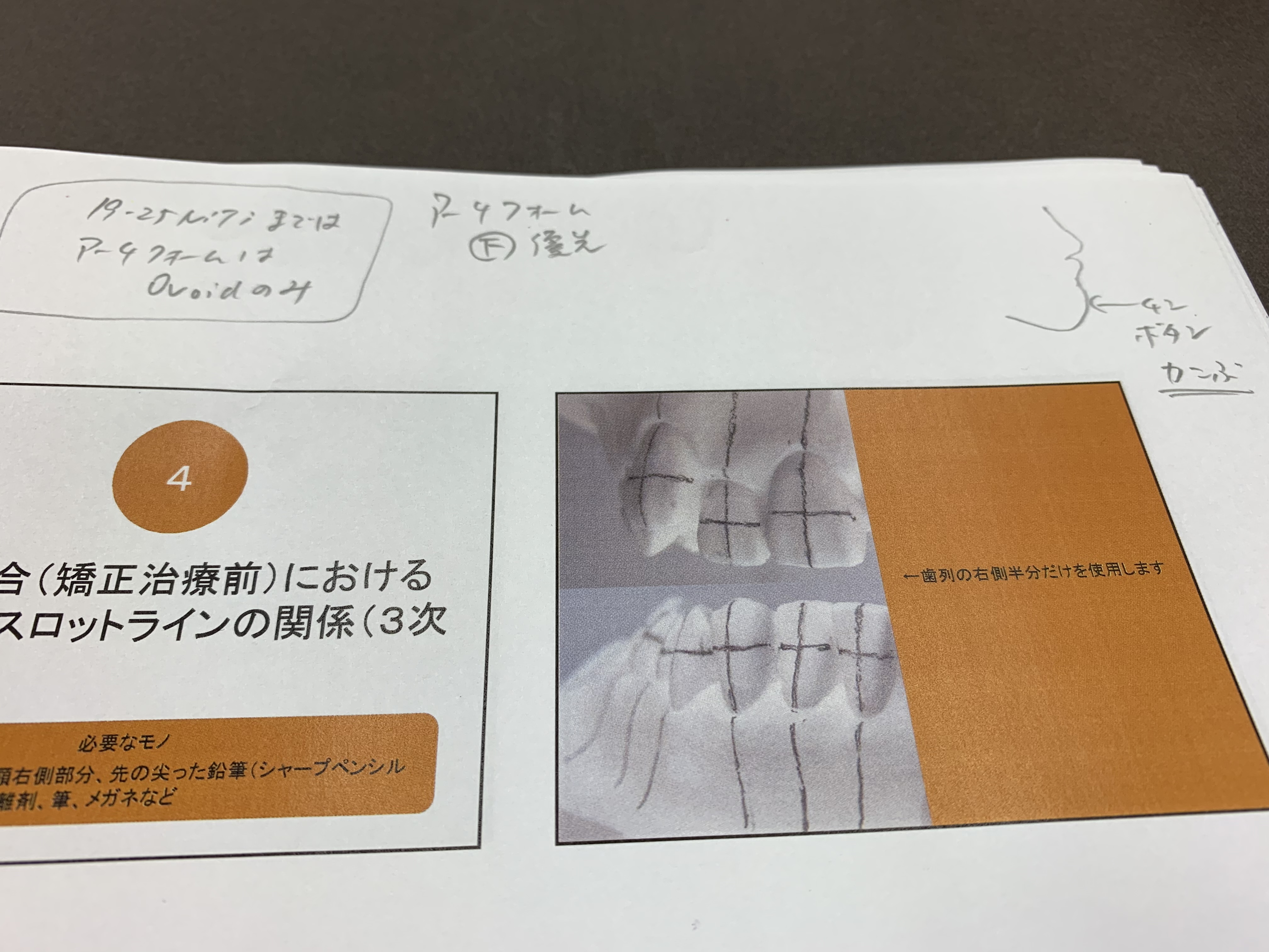 ストレートワイヤーエッジワイズシステムの臨床 | ブログ | 羽村市