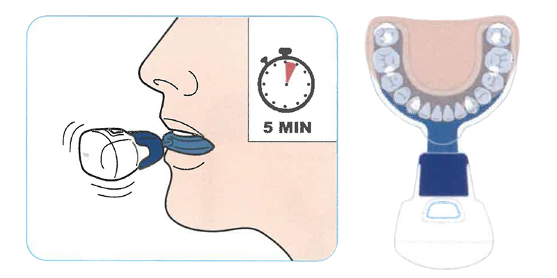 神戸市灘区 マウスピース矯正 シュアスマイル｜うしじま歯科・矯正歯科