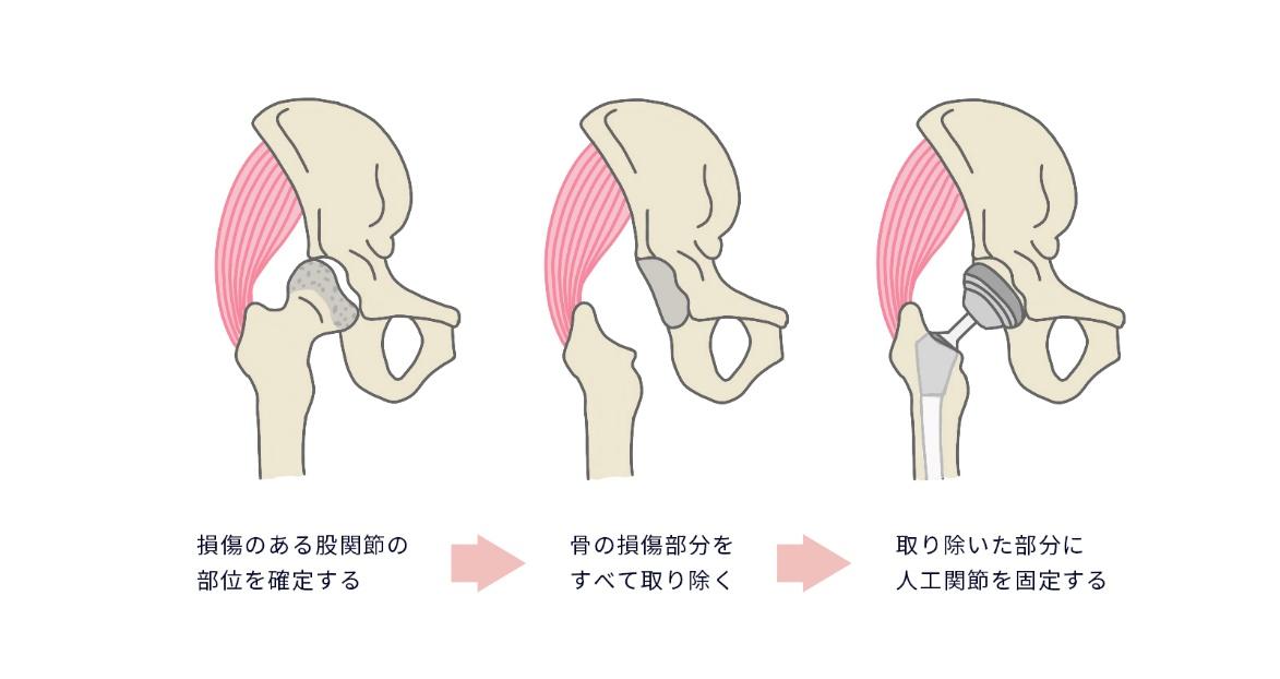 人工股関節置換術｜メリット・デメリット、手術後の生活について