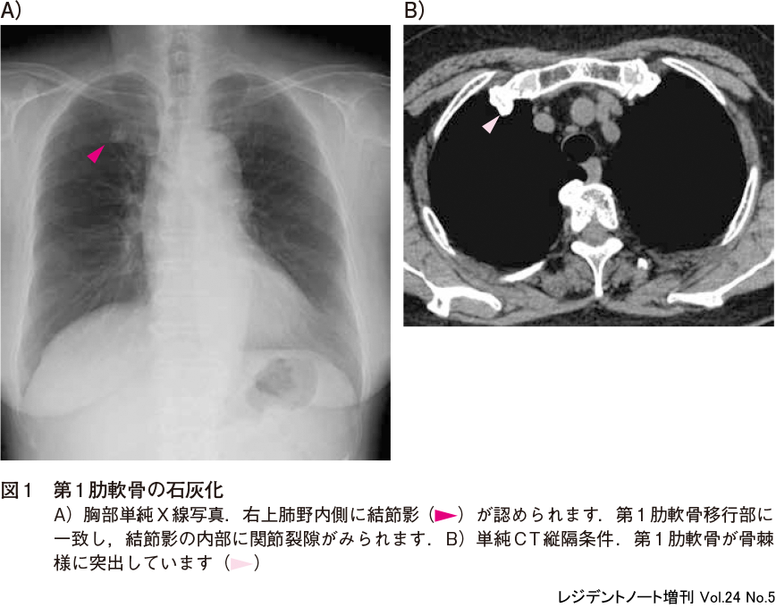 レジデントノート増刊：読影力がグッと上がる！胸部X線写真・CTの