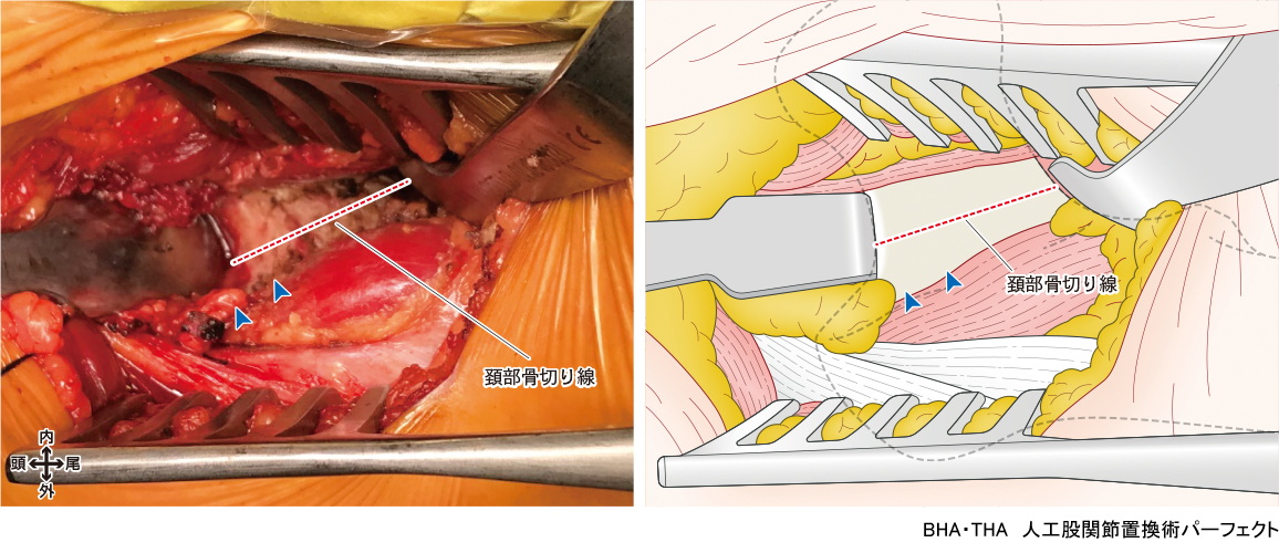 BHA・THA 人工股関節置換術パーフェクト〜人工骨頭置換術・人工股関節