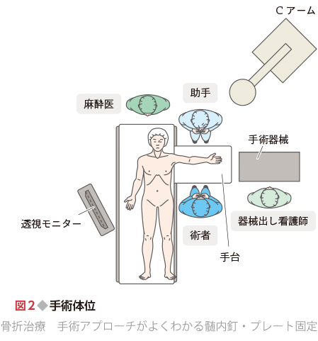 骨折治療 手術アプローチがよくわかる髄内釘・プレート固定 - 羊土社
