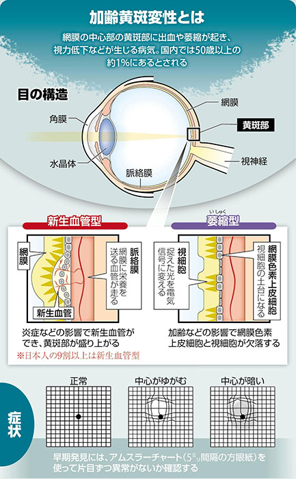 加齢黄斑変性 なぜ発症？ 症状は視力が下がる、中心部が暗くなる