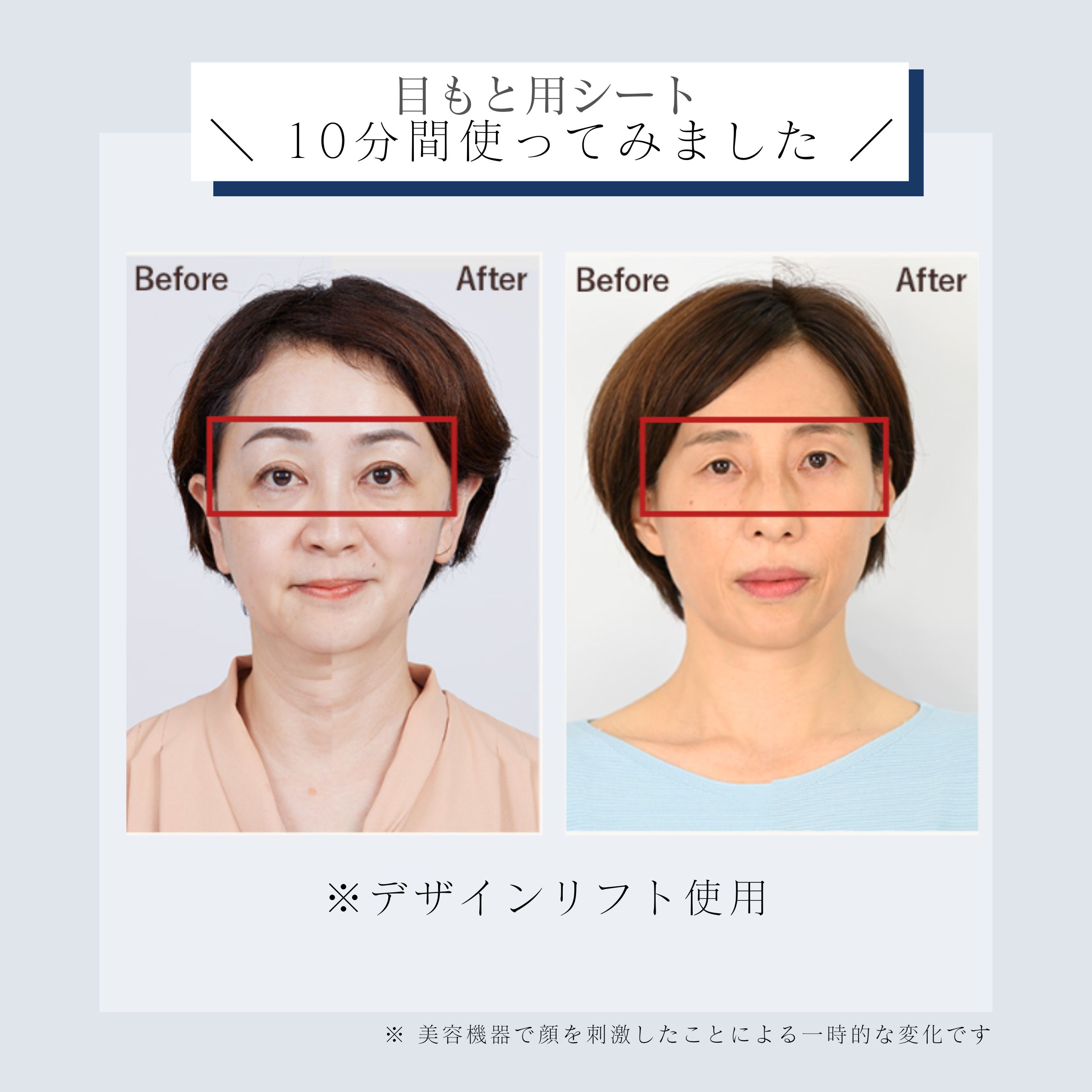 デザインリフトモア口もと集中4ヵ月コースN（C1）｜ヤーマン公式通販