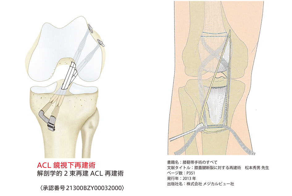 Leeds-Keio補強用メッシュⅡ 人工靭帯 - 医療機器の輸入・製造販売業者