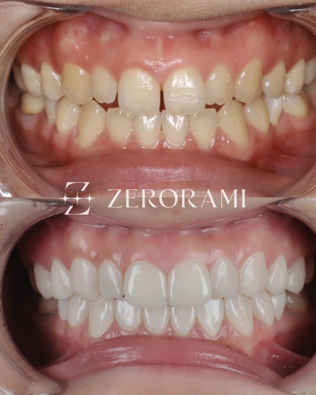 ZERO RAMI(ゼロラミ) – 歯を削らないセラミック(ラミネートベニア