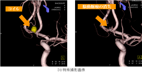 脳動脈瘤コイル塞栓術 | 藍の都脳神経外科病院