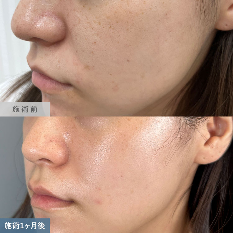 ピコレーザー | スキンケア（美白・しみ・肝斑） | 美容整形はTCB東京