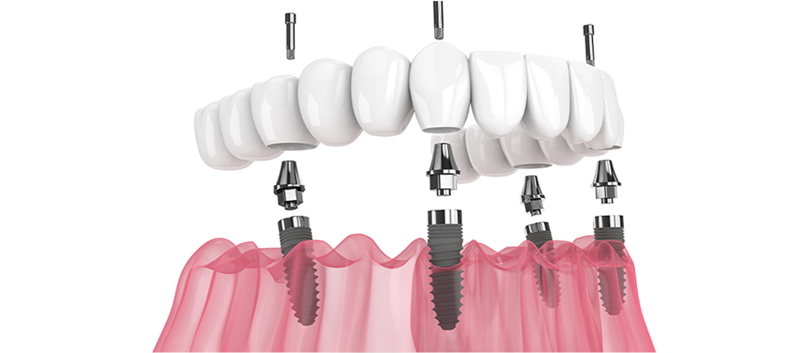 裁断済み】インプラントセラピー 第2版 裁断済み】インプラント