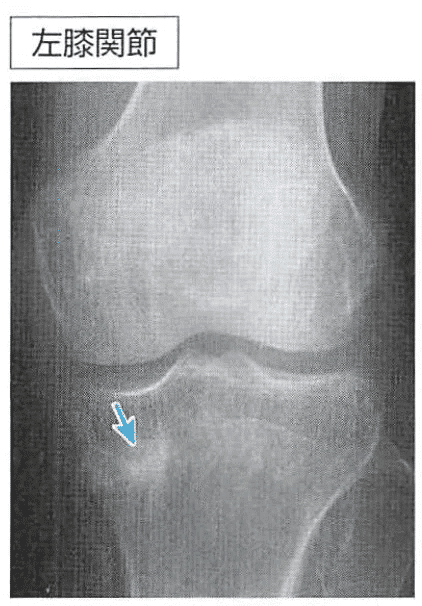 整形外科専門医試験2025年第37回問1｜Drひろひろ@整形外科専門医試験対策