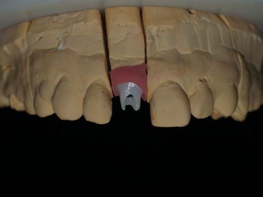 プロビジョナルレストレーション – 【公式】広島市の歯科技工所「株式